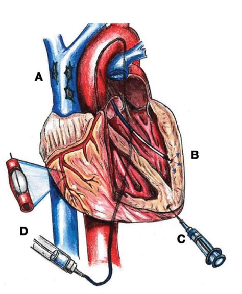 Various Approaches For Stem Cell Delivery To The Heart A Intravenous