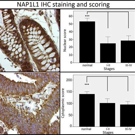 Staining Patterns And Scoring Results For β Catenin Nuclear And