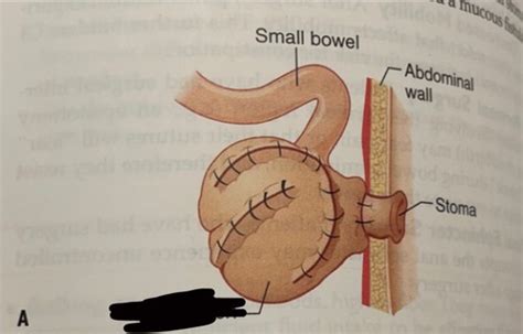 Bowel Elimination Chapter 26 Flashcards Quizlet