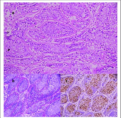 A Photomicrograph Showing Islands Of Tumor Cells Arranged In A Jigsaw