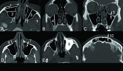 Computed Tomography Measurements Of Different Dimensions Of Maxillary