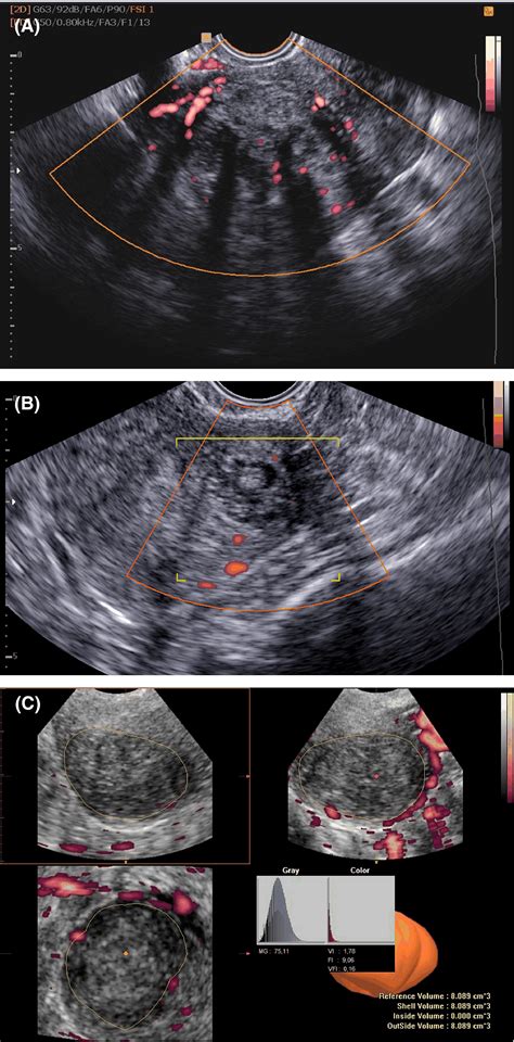 Fibroid Vascularisation Assessed With Threedimensional Power Doppler