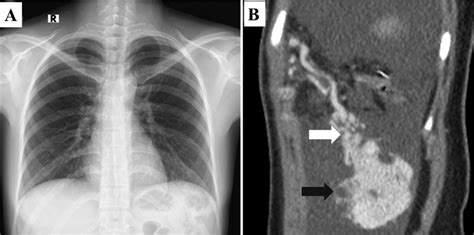 Chest X Ray And Detection Of A Retroperitoneal Solitary Fibrous Tumor