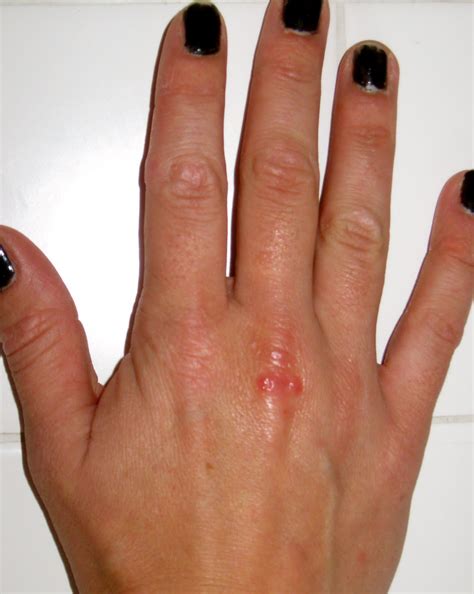 Aimee's Thoughts Today: Ew! Warts!