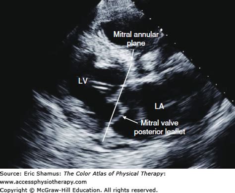 Mitral Valve Prolapse | AccessMedicine Network