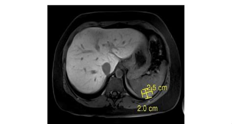 Mri Abdomen Showing Splenic Granuloma Axial Section Download