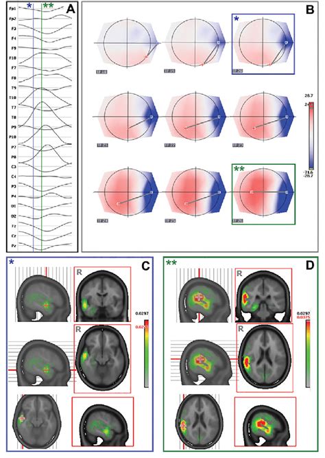 Electric Source Imaging Of Averaged Ictal Waveforms Using A Distributed