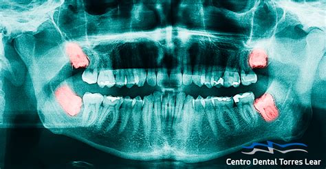 Cu Ndo Quitar Las Muelas Del Juicio Centro Dental Torres