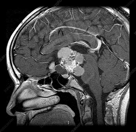 Mri Of Craniopharyngioma Stock Image C Science Photo Library