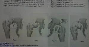 Fraturas Da Cabeça Femoral Traumatologia E Ortopedia