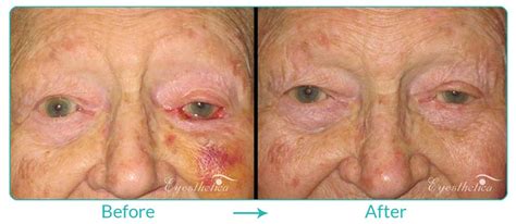 Eyelid Lesion Removal Gallery LA - Eyesthetica