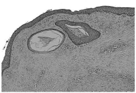 Prominent Daughter Cysts Containing Keratin Whorls H E Staining