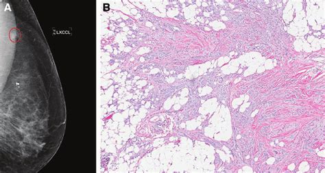 Invasive Ductal Carcinoma Type