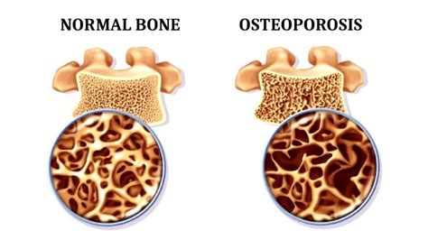 What Causes Osteoporosis - The Guardian Mobile