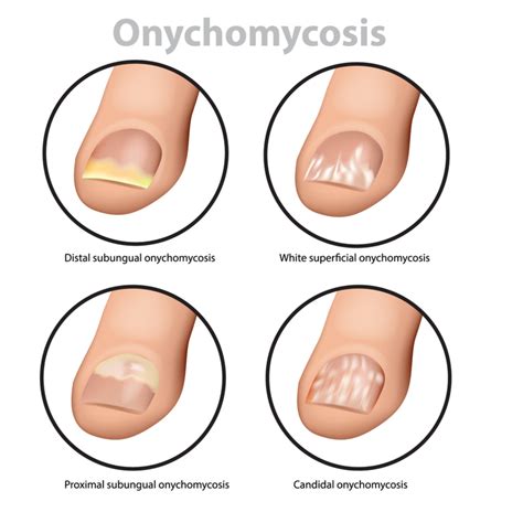 Symptoms of a Nail Infection – Fungus Therapy – fungustherapy.com