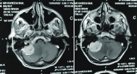 Magnetic Resonance Imaging Brain T1 Weighted Postcontrast Sequences