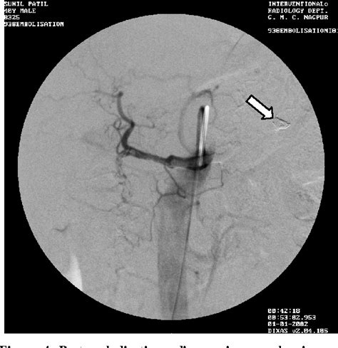 Figure 4 From Endovascular Embolisation Of Giant Ruptured Proximal