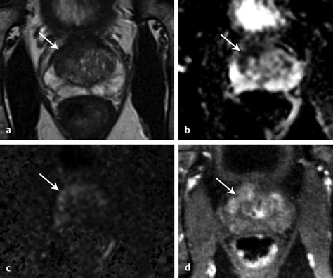 Introduction To Prostate Cancer Clinical Considerations Radiology Key