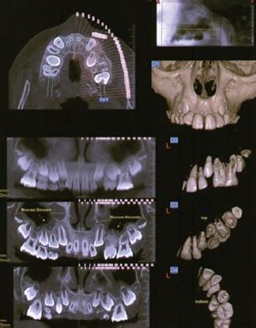 Fig Lutilizzo Della Cbct Pu Essere Un Valido Ausilio In Alcuni