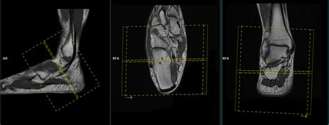 Peroneal tendon MRI protocol and planning