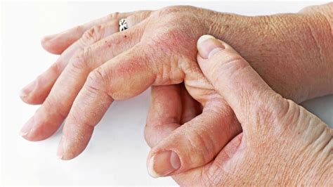 Was Bei Rheumatoioder Arthritis Zu Tun Ist Landesschau Rheinland