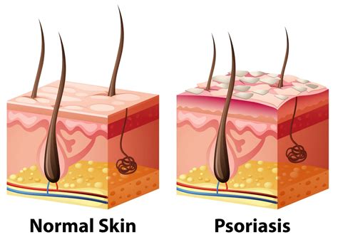 Top Dermatologist Recommended Treatments For Psoriasis Sba Dermatology