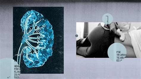 Medullary Sponge Kidney