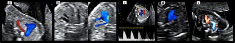 Gray Scale Color Doppler And Spectral Doppler Images Of Arsa And