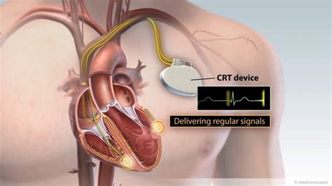 Cardiac Resynchronization Therapy Phoenix Az And Tempe Az Arizona