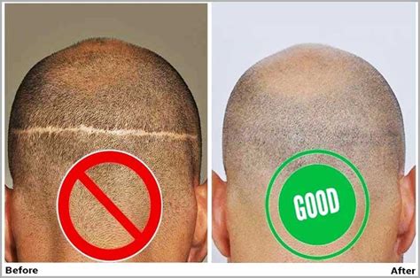 Hair Transplant Before And After Scar