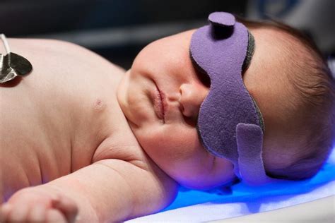 Understanding Phototherapy For Newborn Jaundice Neopededu