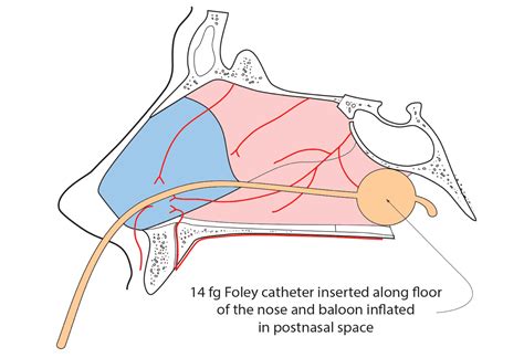 Anterior Nasal Packing