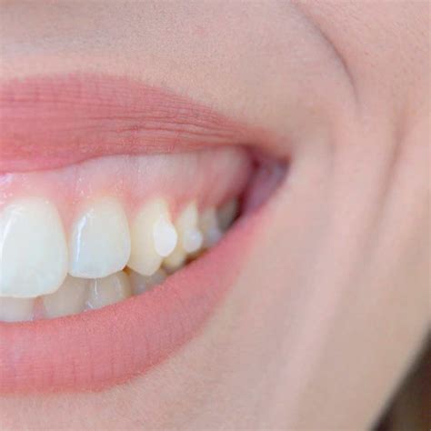 Qu Son Los Ataches De Invisalign Y C Mo Se Colocan Cl Nica Dental