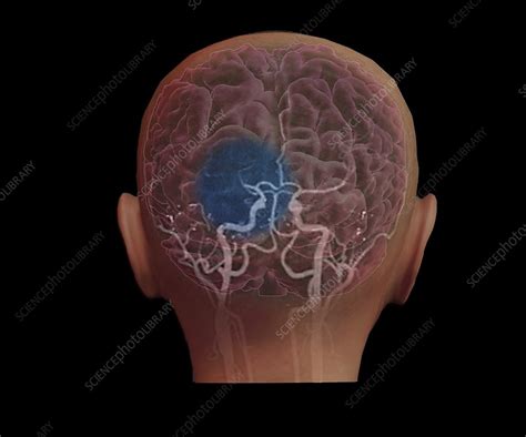 Stroke, MRI scan - Stock Image - C052/9217 - Science Photo Library