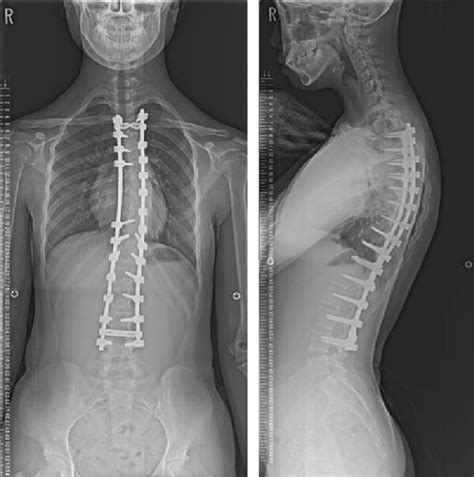 Case 2 Radiographs Anteroposterior Lateral 2 Years After Surgery Download Scientific