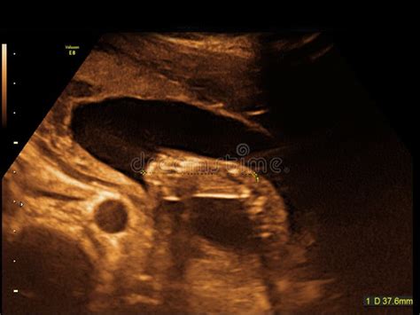 Baby on the Ultrasound Image Stock Photo - Image of pregnancy, body ...