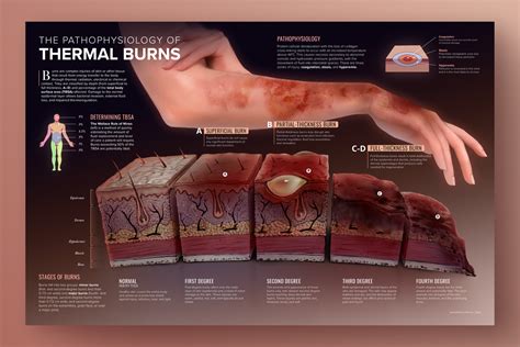 Thermal Burns Spread — Home Viktoriya Khymych