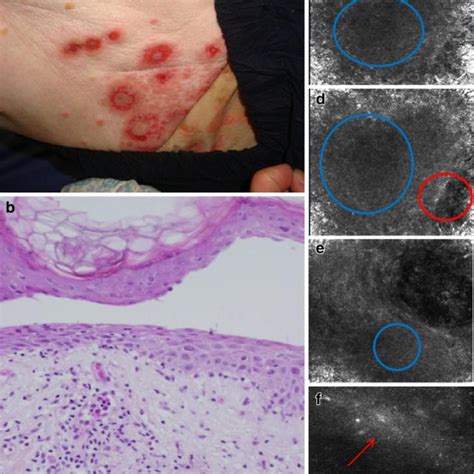 Bullous Pemphigoid A Tense Blisters Confocal Microscope Probe Is Seen Download Scientific