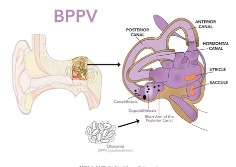 Using The Bow And Yaw Maneuver To Treat Bppv Vertigo Detective