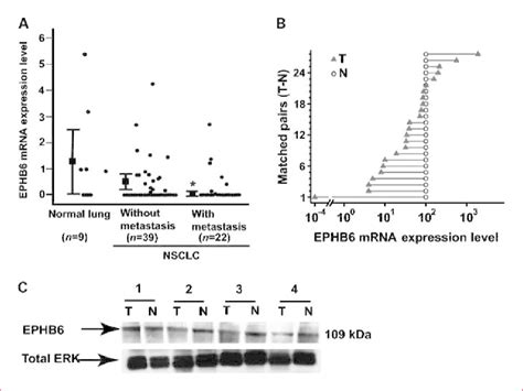 Suppression Of EPHB6 Expression In NSCLC Patients A EPHB6 MRNA