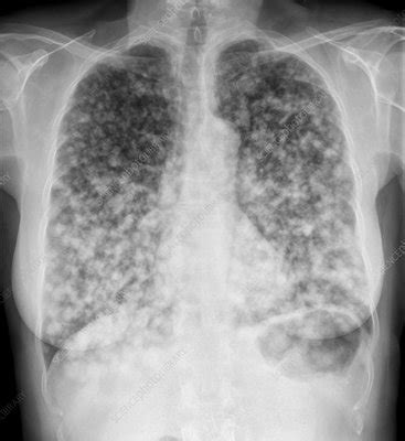 Secondary Lung Cancer X Ray Stock Image C039 1626 Science Photo