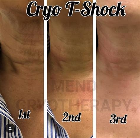 Cryo T Shock Fat Slimming Toning Cool Sculpting The Blend