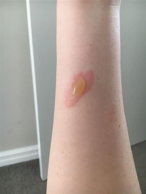 Progression Of A 2nd Degree Burn From Touching A Hot Kettle R