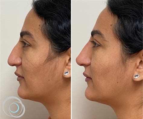 La rhinoplastie médicale Centre Laser Paris Sorbonne Soins