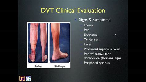 Internal Medicine Grand Rounds Deep Vein Thrombosis Mp4 Youtube