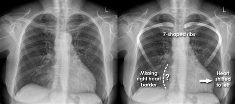 Pectus Excavatum Sternum