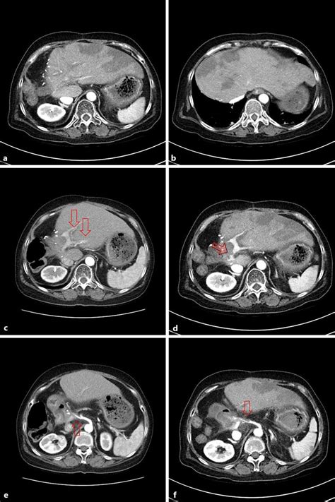 A B Abdominal Contrast Enhanced Ct Showing Multiple Peripheral Download Scientific Diagram