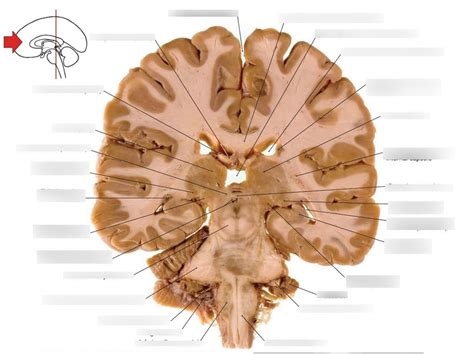 The Rostral Surface Of A Coronal Section Of Brain Through The Pulvinar