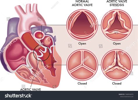 4,287 Aortic Valve Images, Stock Photos & Vectors | Shutterstock