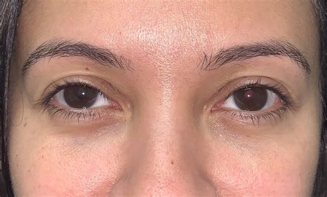 18 Upper Eyelid Surgery Before And After Photos Dallas Plano Texas Cosmetic Reconstructive